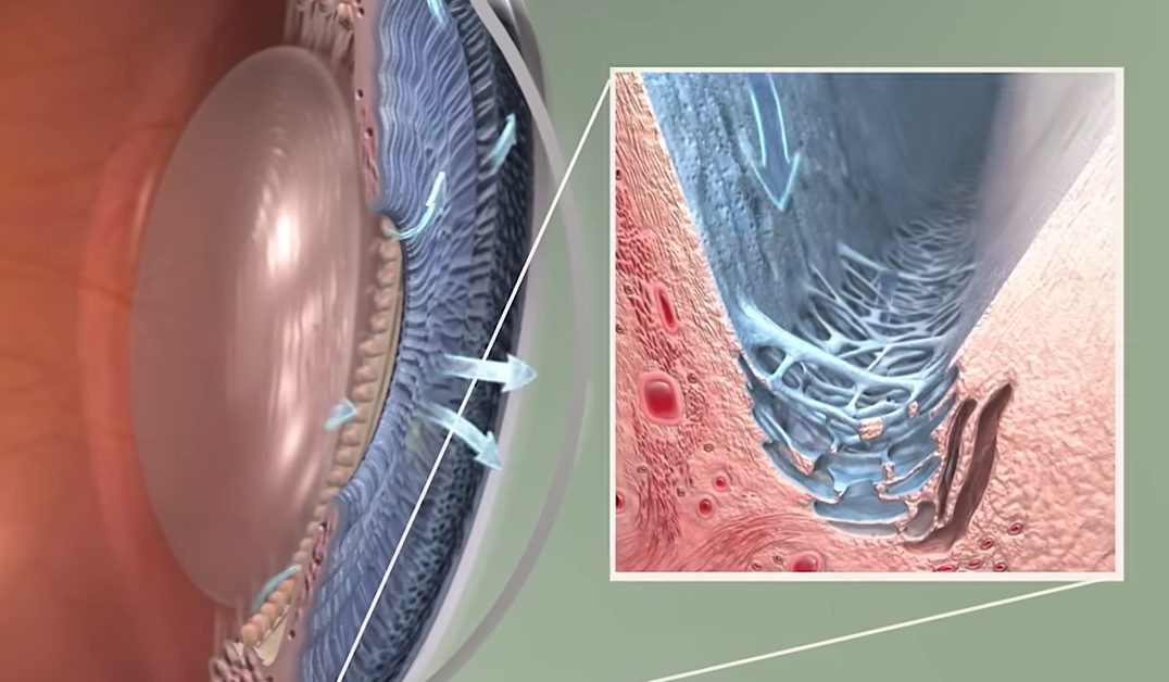녹내장 초기증상