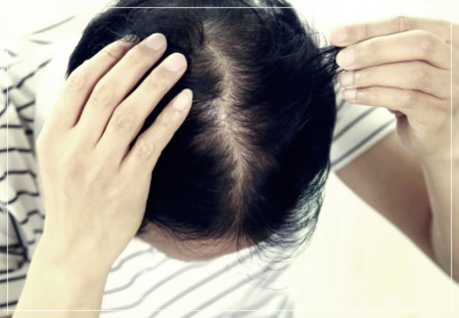두피땀 원인으로 탈모가 생긴다면?