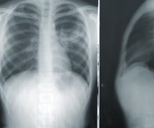 오른쪽 갈비뼈 아래 통증 원인 대처법