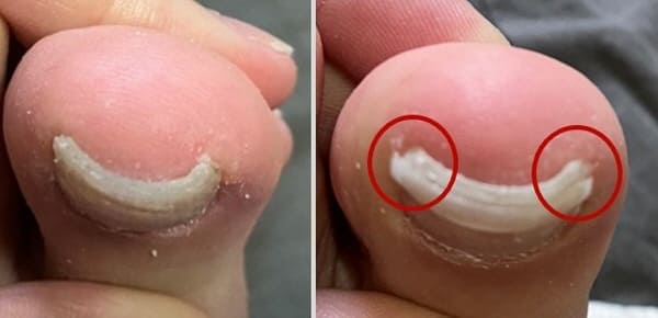 내성발톱자가교정