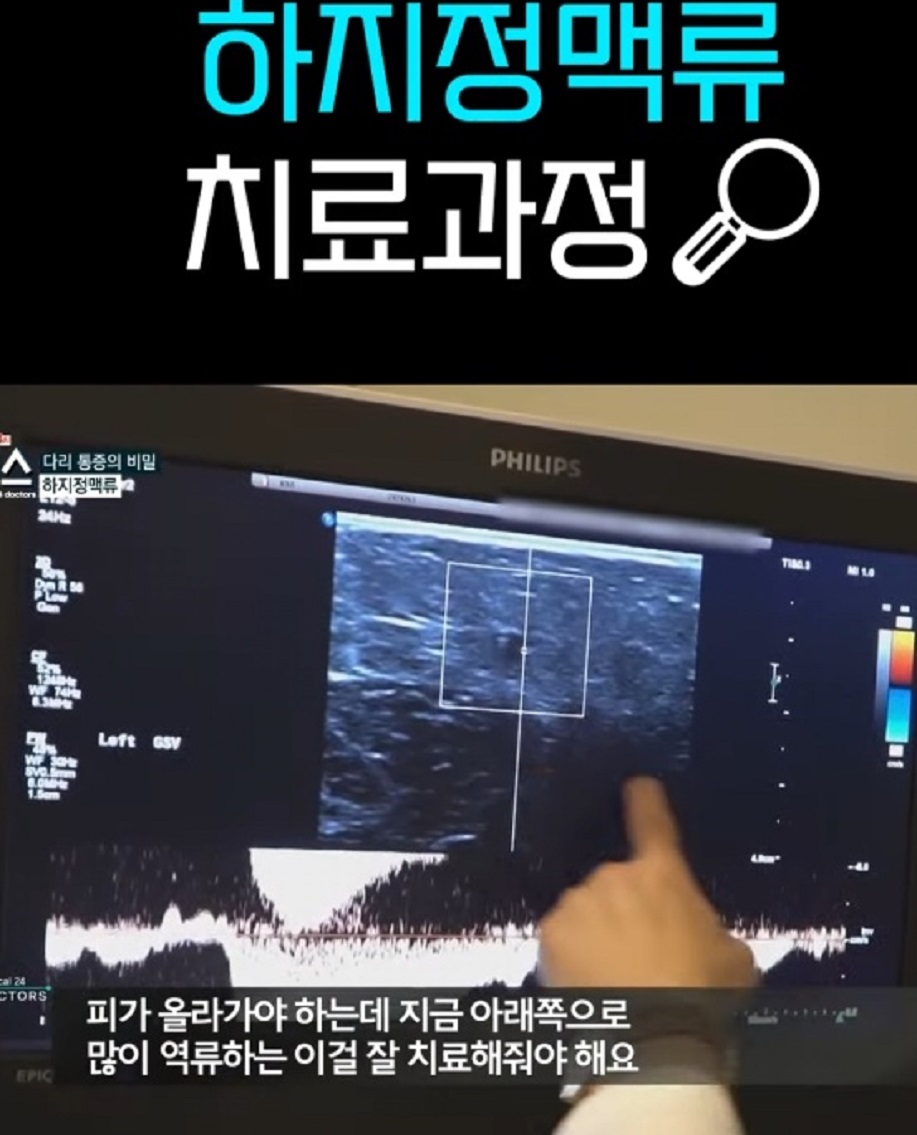 박기혁-교수-하지정맥류