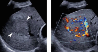 3~5 cm hcc sono features