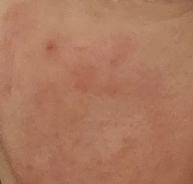 화장품 부작용의 증상&amp;#44; 치료 방법&amp;#44; 주의할 점 (피부 트러블)