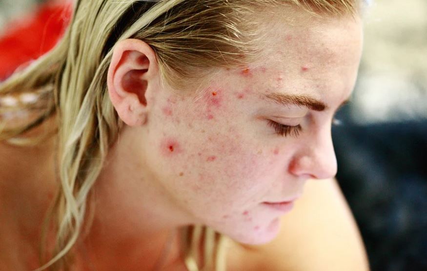 여드름많은여자