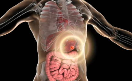 위암 4기 생존율