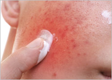 애크논 크림, 효과, 가격, 사용법