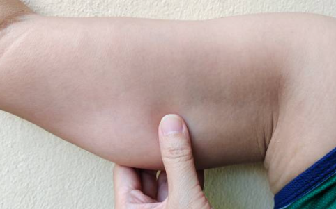 겨드랑이 림프절