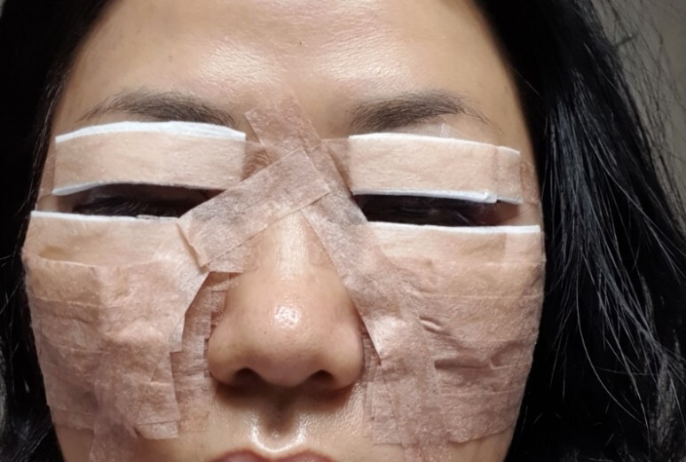 하안검 수술 후기