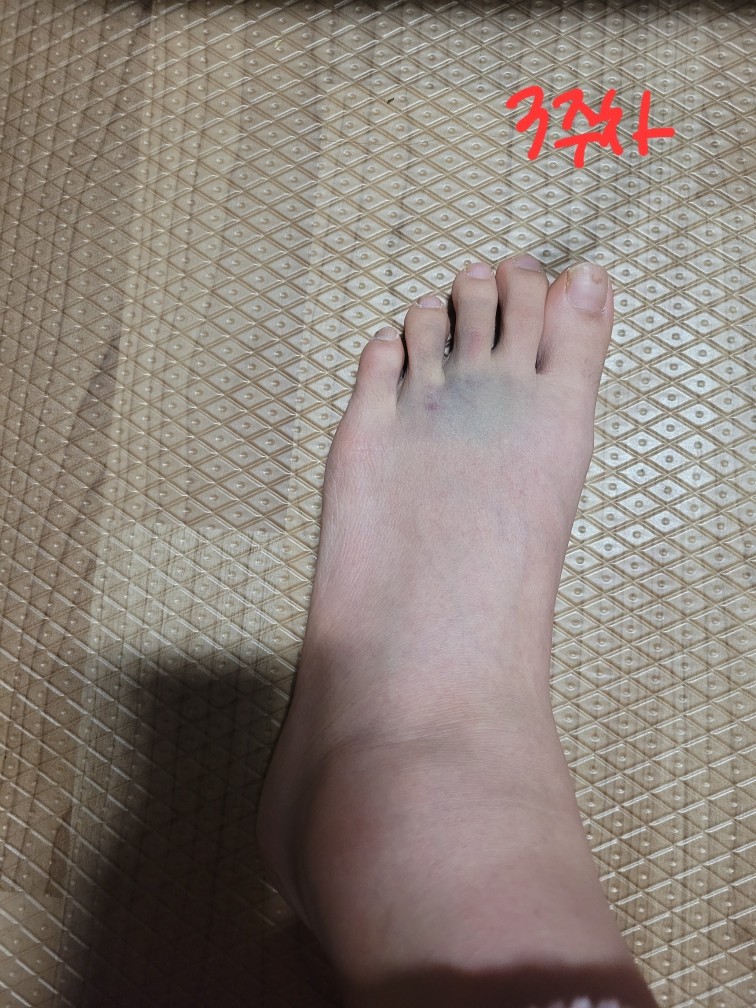 발목-접질렀을-때