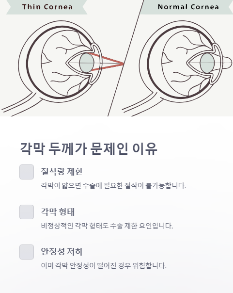 각막 두께가 문제인 이유