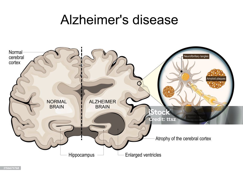 치매의 모든 것: 증상, 원인, 예방 및 치료 방법까지