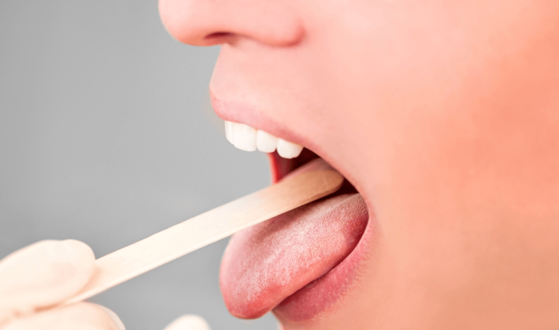 혀-갈라짐-치료