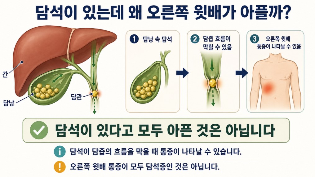 담낭 안의 담석이 담즙의 흐름을 막으면서 오른쪽 윗배 통증을 일으킬 수 있는 과정을 설명한 이미지