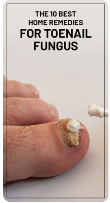 발톱-무좀-증상