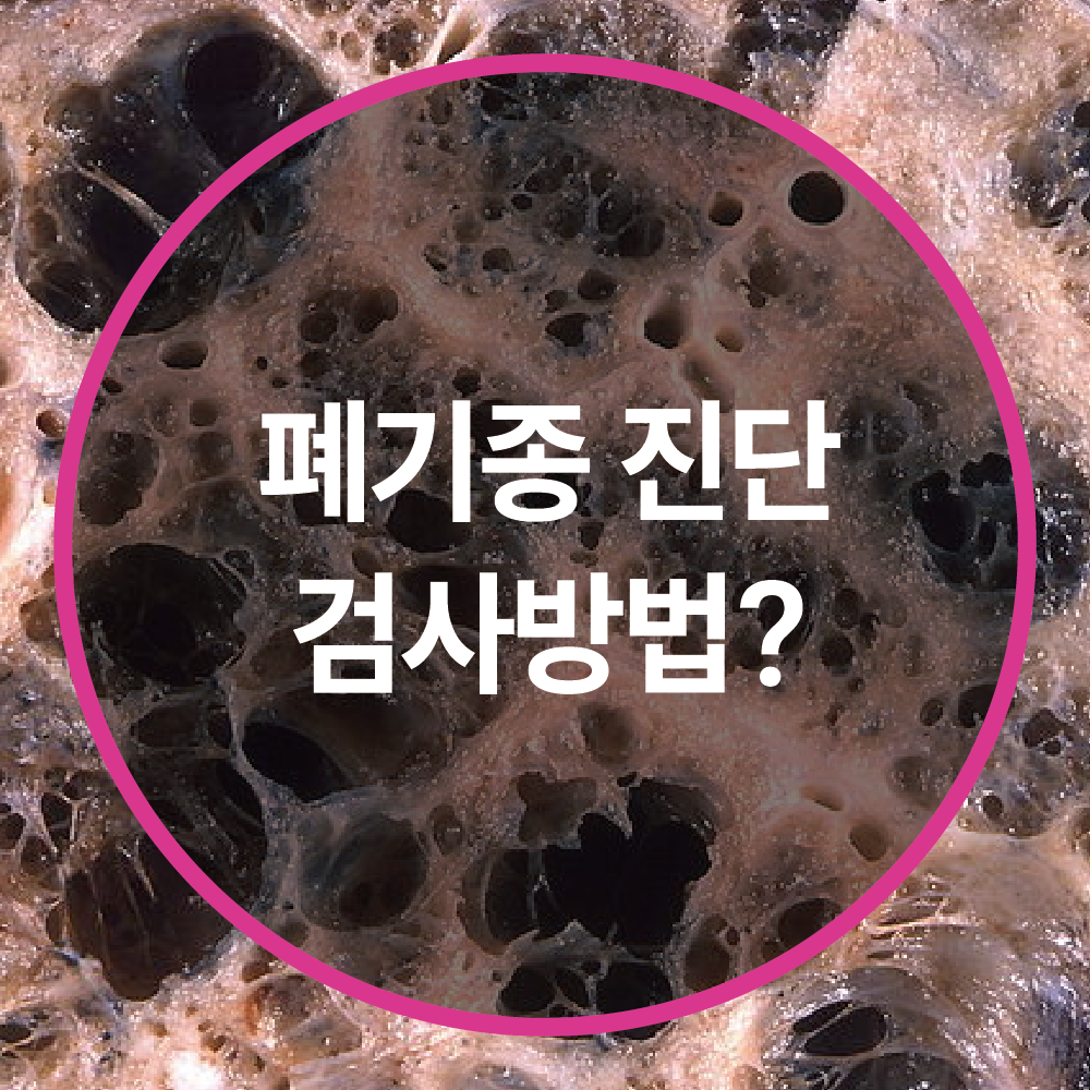 폐기종 진단 검사 방법: 정확한 진단을 위한 필수 가이드