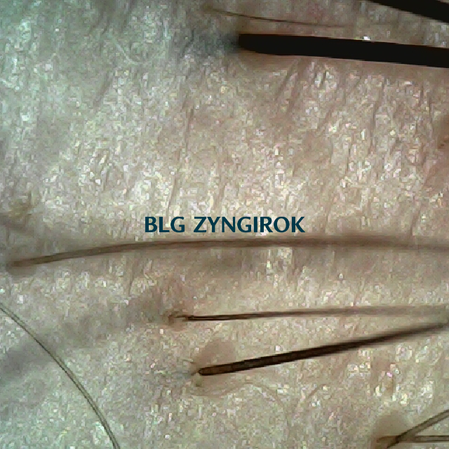 탈모 극복 프로젝트 - 오른쪽 M자 부위 두피모습이다.