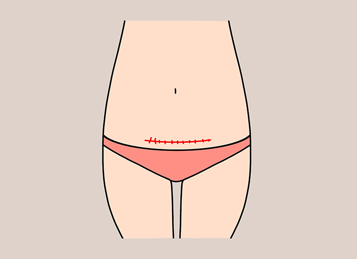 제왕절개를-완료한-모습