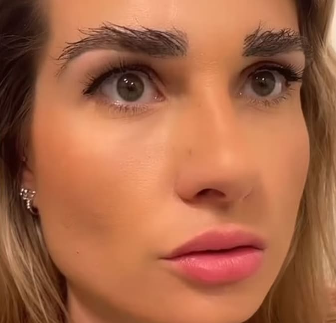 자신의 머리 털로 눈썹 이식한 10대...어머! 숯덩이네! VIDEO:Cotswolds woman undergoes eyebrow transplant using hairs from head