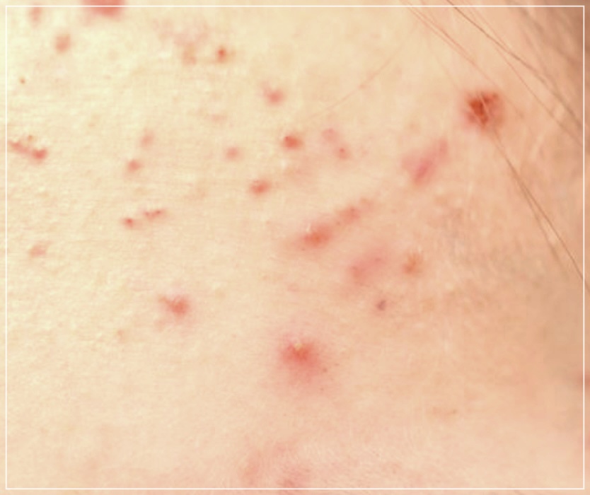 결절성 여드름 관리 잘하는 방법 3가지