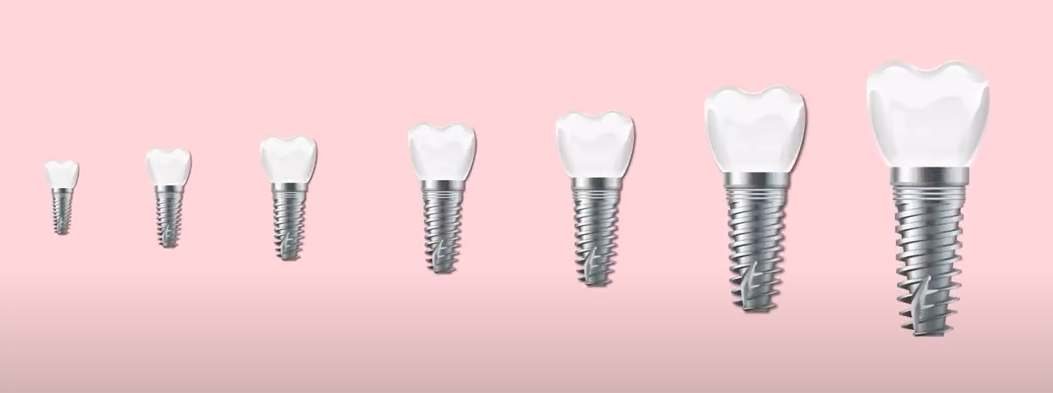 뼈이식이 필요한 경우