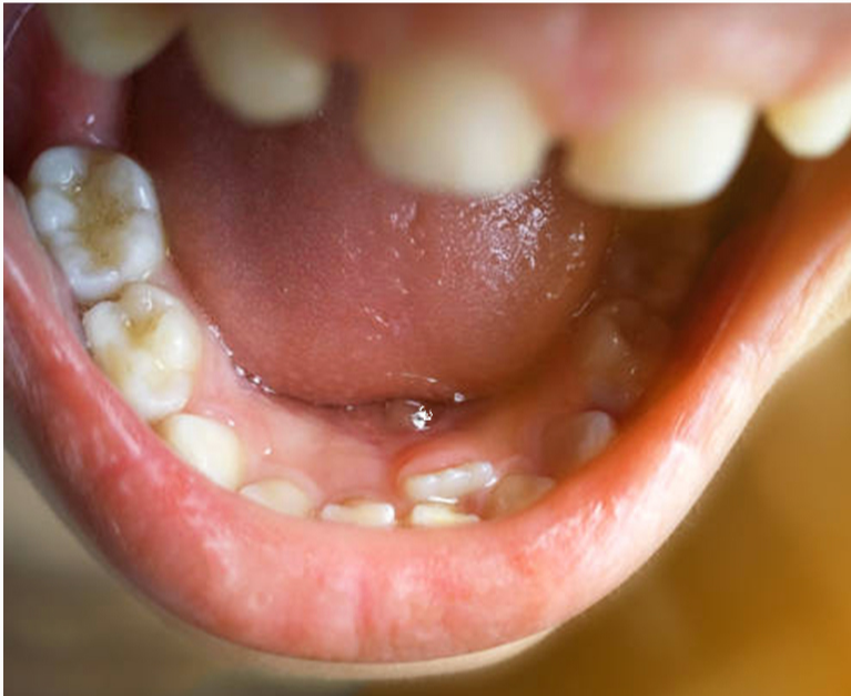 유치 나는 순서 시기, 유치 빠지는 순서 시기, 영구치 나는 순서 시기