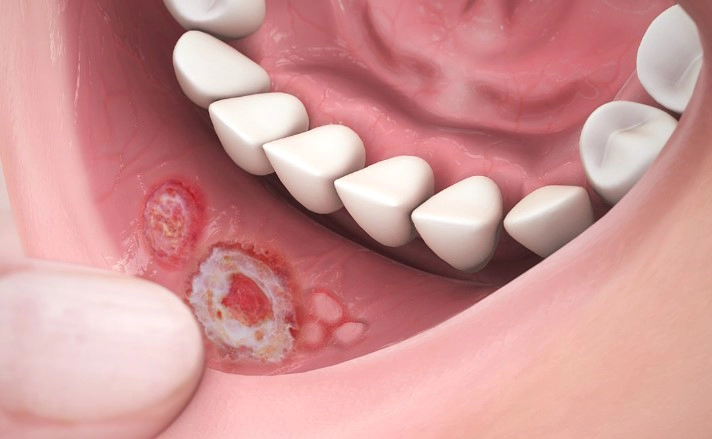 구내염 원인 증상 전염 빨리 낫는 치료법 깔끔 정리