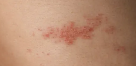 오른쪽 옆구리 통증 의심되는병 6