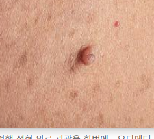 쥐젖 제거방법 알아보기