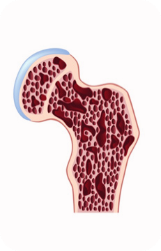 골다공증-치료방법