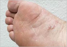 카네스텐 연고가 필요한 무좀 증상 발 이미지