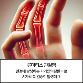 효과적인 류마티스 관절염 치료제 추천 약물 비교 가이드 2025 최신판_14