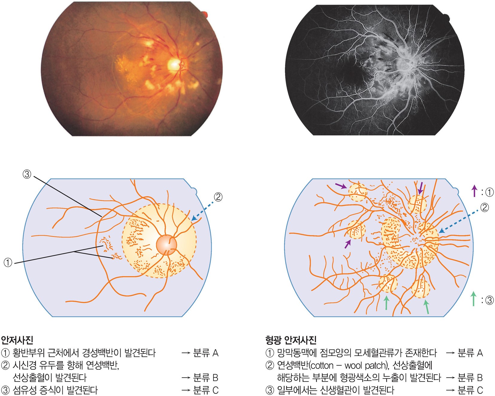 당뇨망막병증