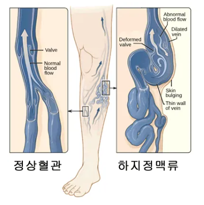 하지정맥류