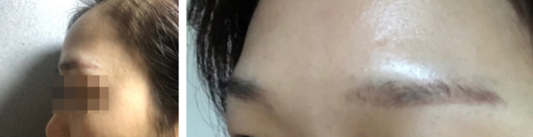 이마 미간 보톡스 후기5