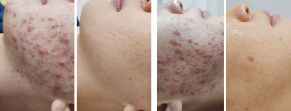 화농성 여드름 치료 전과 후 모습