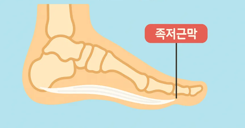 족저근막염 증상