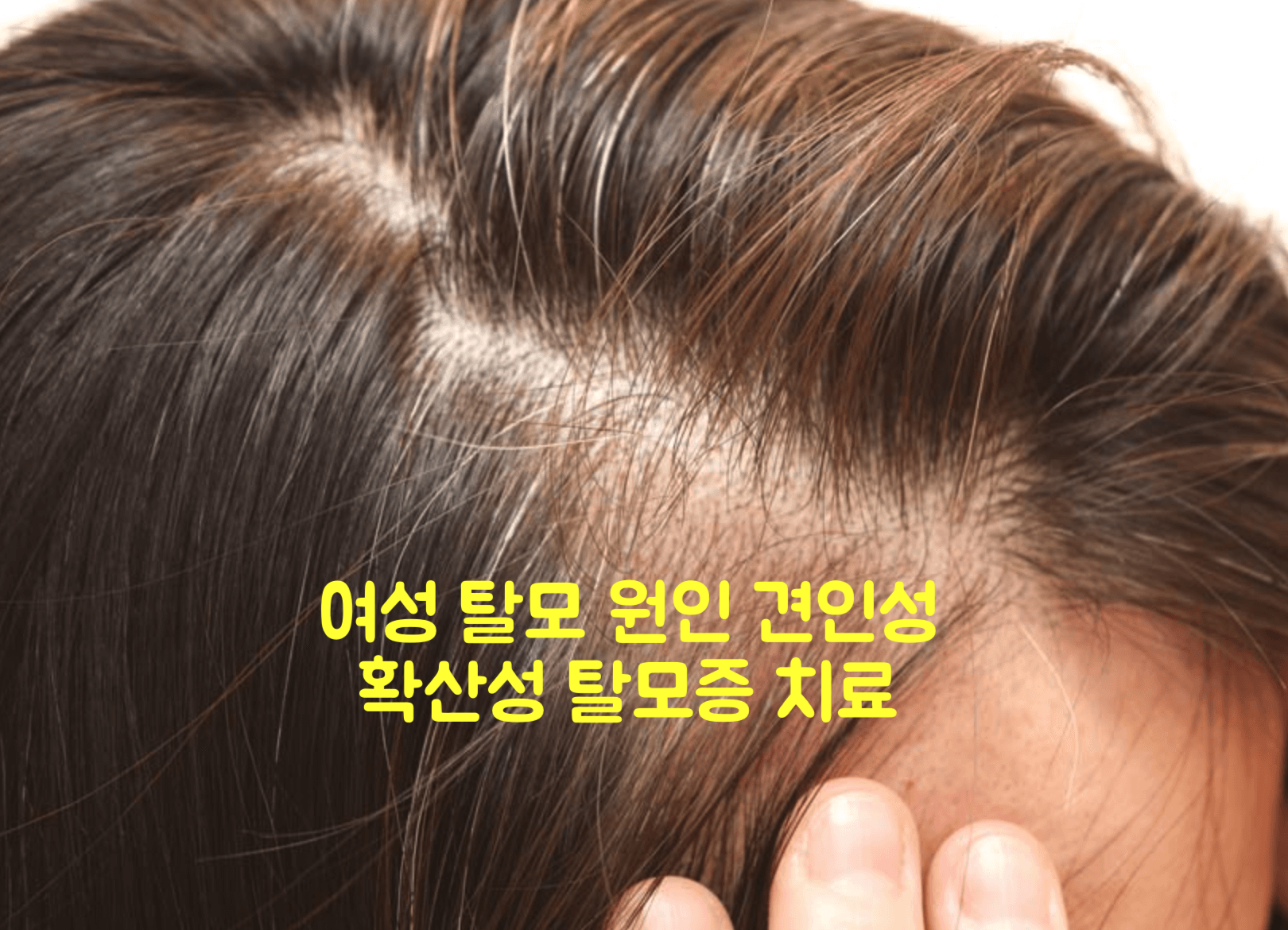 여성 탈모증