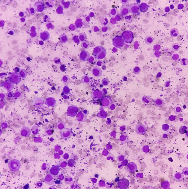 골수증식성 질환 증상