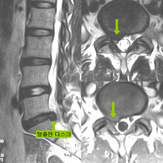 요추 추간판 탈출증 출처 대한 정형외과 학회 홈페이지