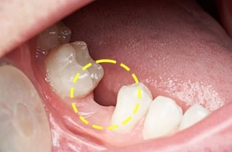 어래-어금니가-빠진-모습