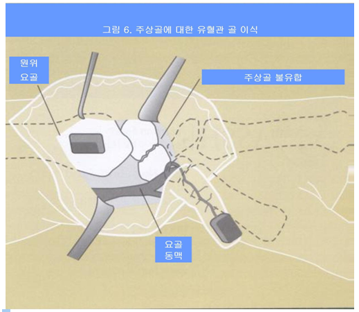 혈관이 부착된 골이식(Vascularized Bone Graft)술
