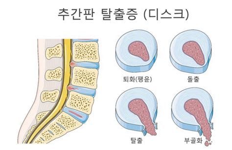 디스크