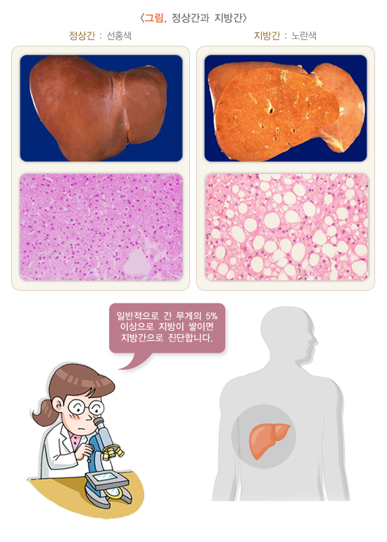 정상간과 지방간을 비교한 그림