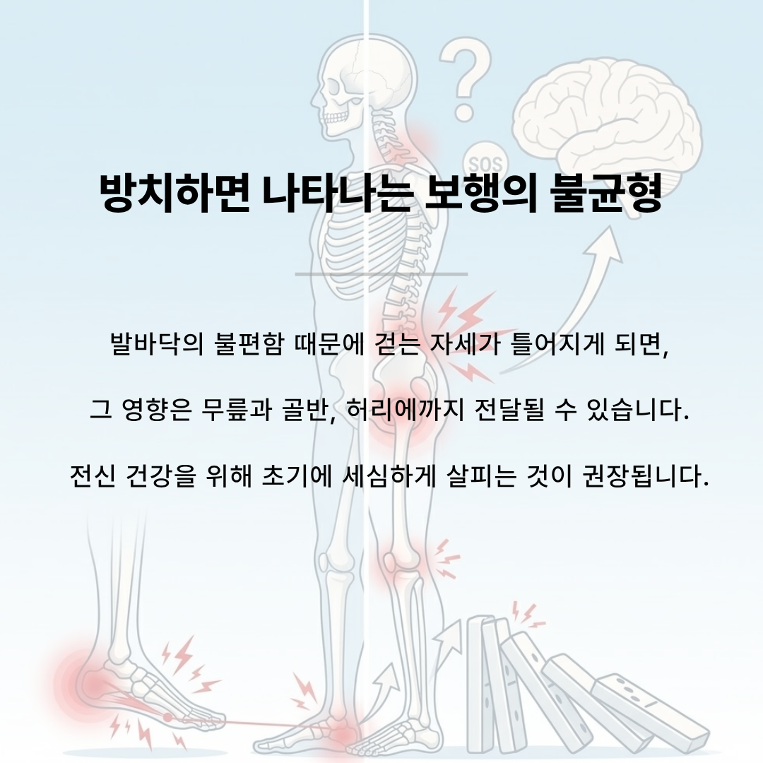 발바닥 통증이 무릎, 골반, 허리 통증 및 전신 불균형으로 이어지는 도미노 효과 일러스트
