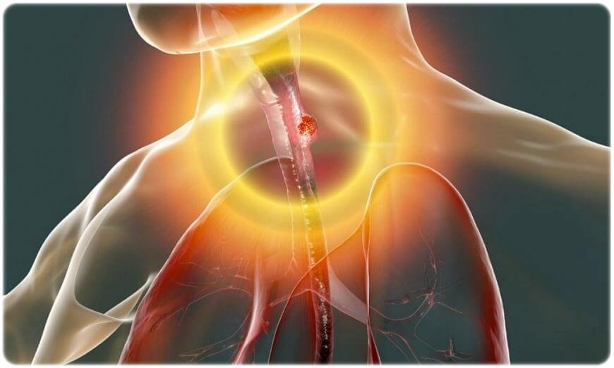 위암 증상 원인 진단 치료 생존율 완치율 예방 방법