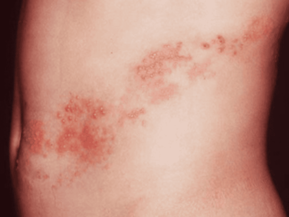 대상포진 예방접종 필요성