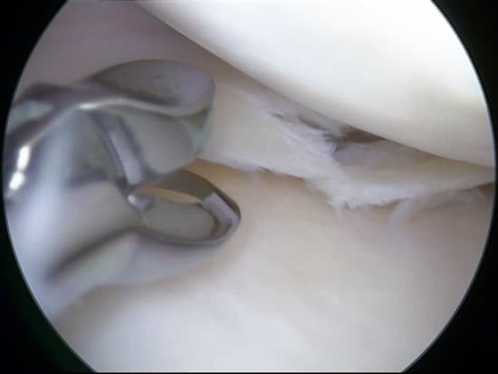 무릎 연골 이식술의 종류