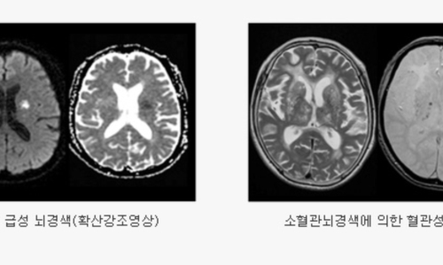 뇌경색 이미지