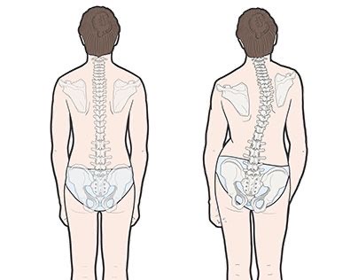 척추측만증 교정운동, 관리법 첨부사진