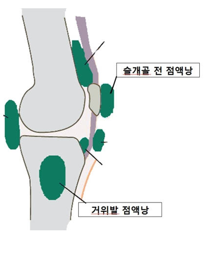 슬개골 전 점액낭염: 원인과 치료 방법 출처 대한 정형외과 학회 홈페이지